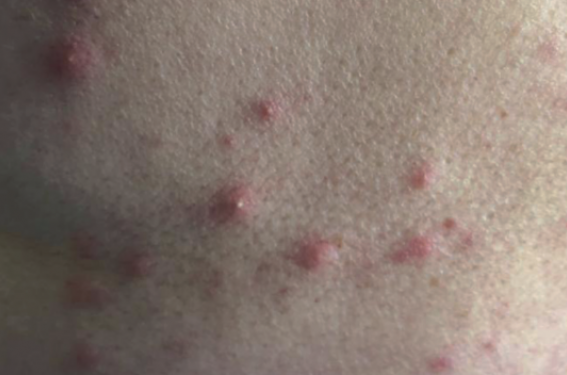 Quel diagnostic évoquer chez cette patiente de 48 ans qui consulte dans le cadre de petites papules érythémateuses, parfois pustuleuses, d’apparition soudaine, au retour de vacances sur la Côte d’Azur ?