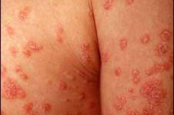 Psoriasis : le bimekizumab agit vite et longtemps