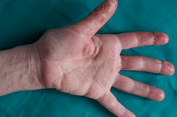 Dermatites des mains, les pièges à éviter
