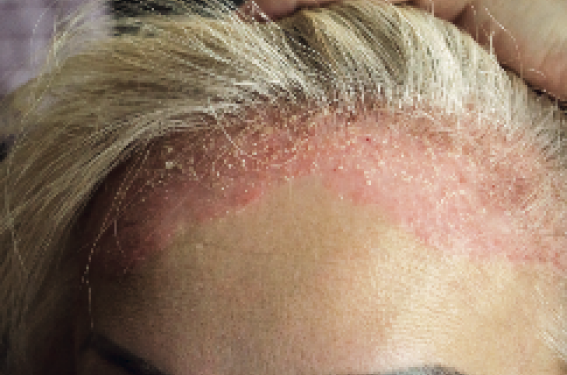Le psoriasis dans tous ses états