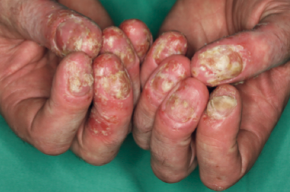 Le psoriasis pustuleux