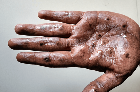 Monkeypox : rappels sur les spécificités cutanées