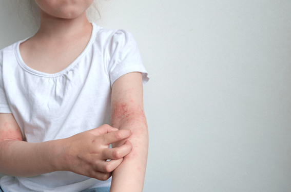 Psoriasis de l’enfant - La place des biothérapies
