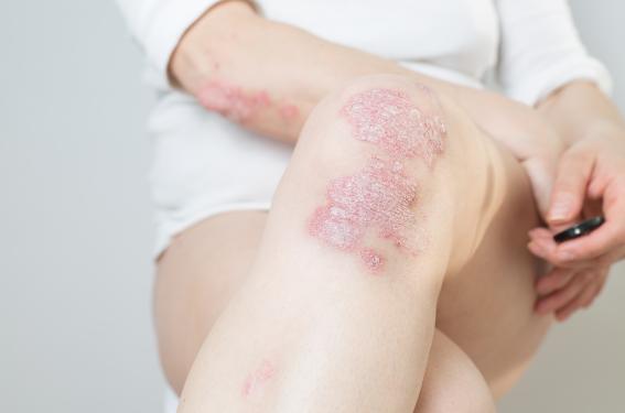 Psoriasis, les nouveaux standards de soins