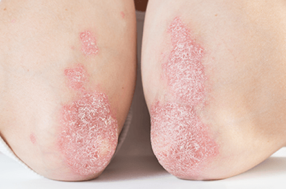Efficacité des anti-TYK2 oraux dans le psoriasis : efficacité d’un essai de phase II