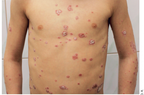 Psoriasis de l’enfant : quelles nouveautés ?