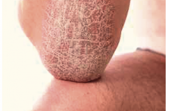 Psoriasis modéré à sévère : quel critère de choix pour le traitement systémique ?