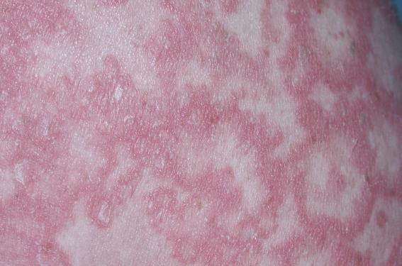 Quelle gestion en pratique du traitement du psoriasis pendant la grossesse ?