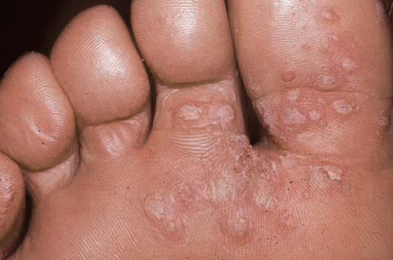 Tumeurs cutanées associées aux papillomavirus humains