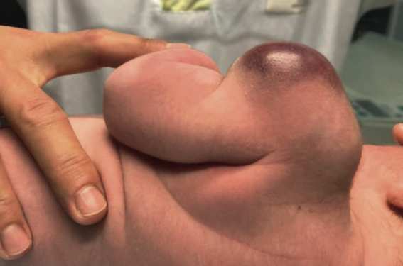 Les tumeurs cutanées malignes de l’enfant