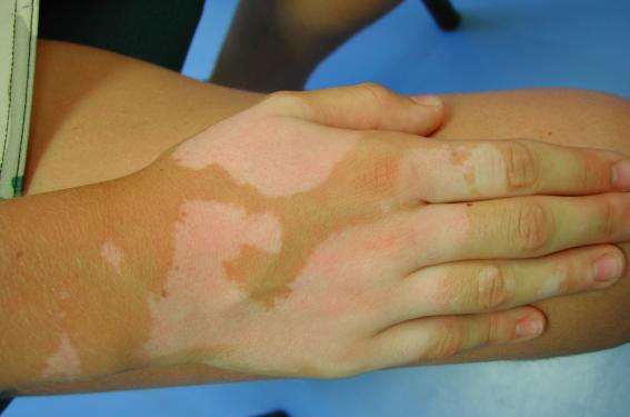 traitement du vitiligo