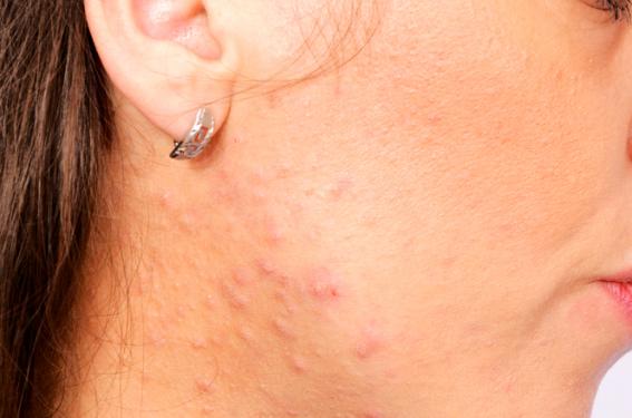 Traitement de l'acné - Des solutions pour remplacer l ...