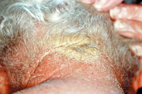 Gales atypiques : un diagnostic piège ! | Dermatologie Pratique