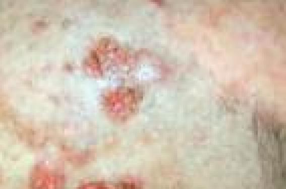 Illustration/Figure 1. Photoallergie au kétoprofène.  