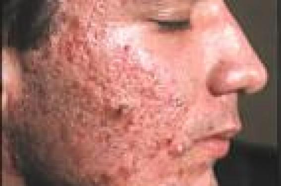 Traitements physiques de l'acné | Dermatologie Pratique