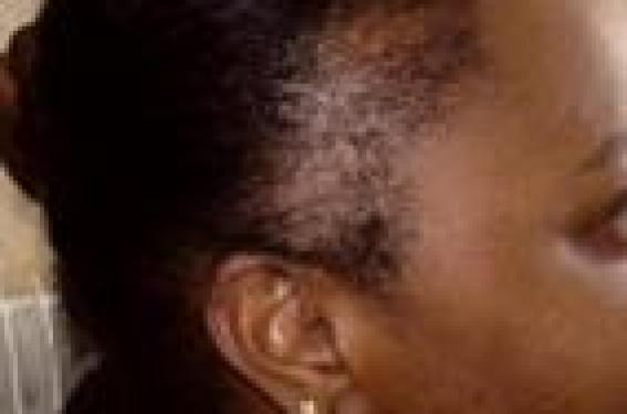 Les cheveux crépus : particularités et traitement des alopécies ...