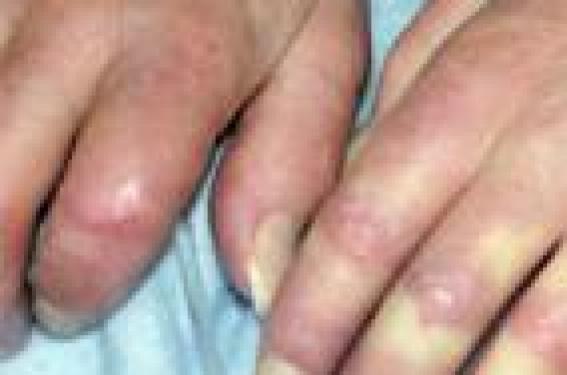 Diagnostic de sclérodermie devant une polyarthralgie à doigts ...