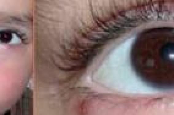 La rosacée oculaire | Dermatologie Pratique